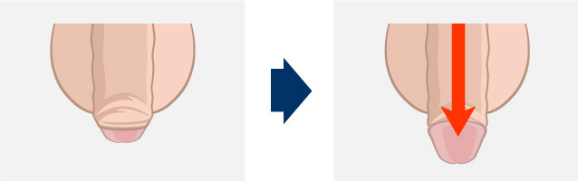 切らない長茎術(埋没法)