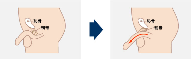 切らない長茎術(埋没法)