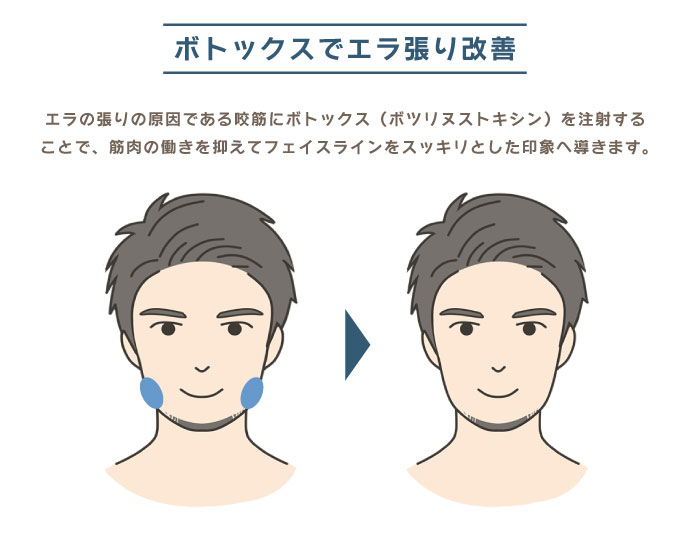 ボトックスでエラ張り改善