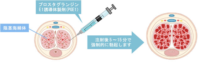 ICI療法(陰茎海綿体注射療法) は新宿御苑メンズクリニックへ