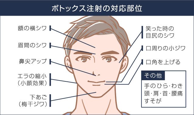 ボトックス注射対応部位