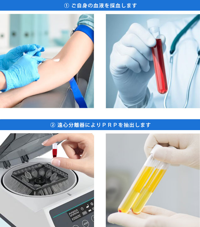 自己血液を使ったED治療 「ICI PRP(多血小板血漿)療法」は新宿御苑メンズクリニックへ