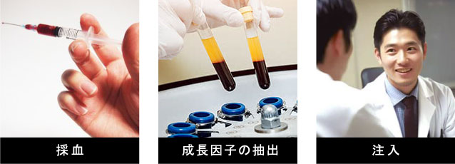 男性器増大PRP×FGF注射は新宿御苑メンズクリニックへ