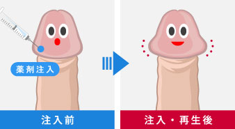 男性器増大PRP×FGF注射は新宿御苑メンズクリニックへ