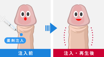 男性器増大PRP×FGF注射は新宿御苑メンズクリニックへ