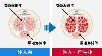 男性器増大PRP×FGF注射は新宿御苑メンズクリニックへ